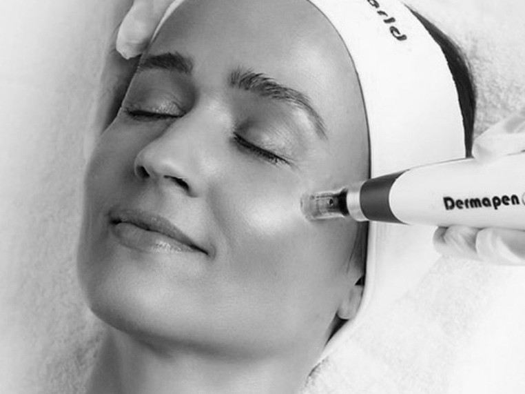 Dermapen Treatment